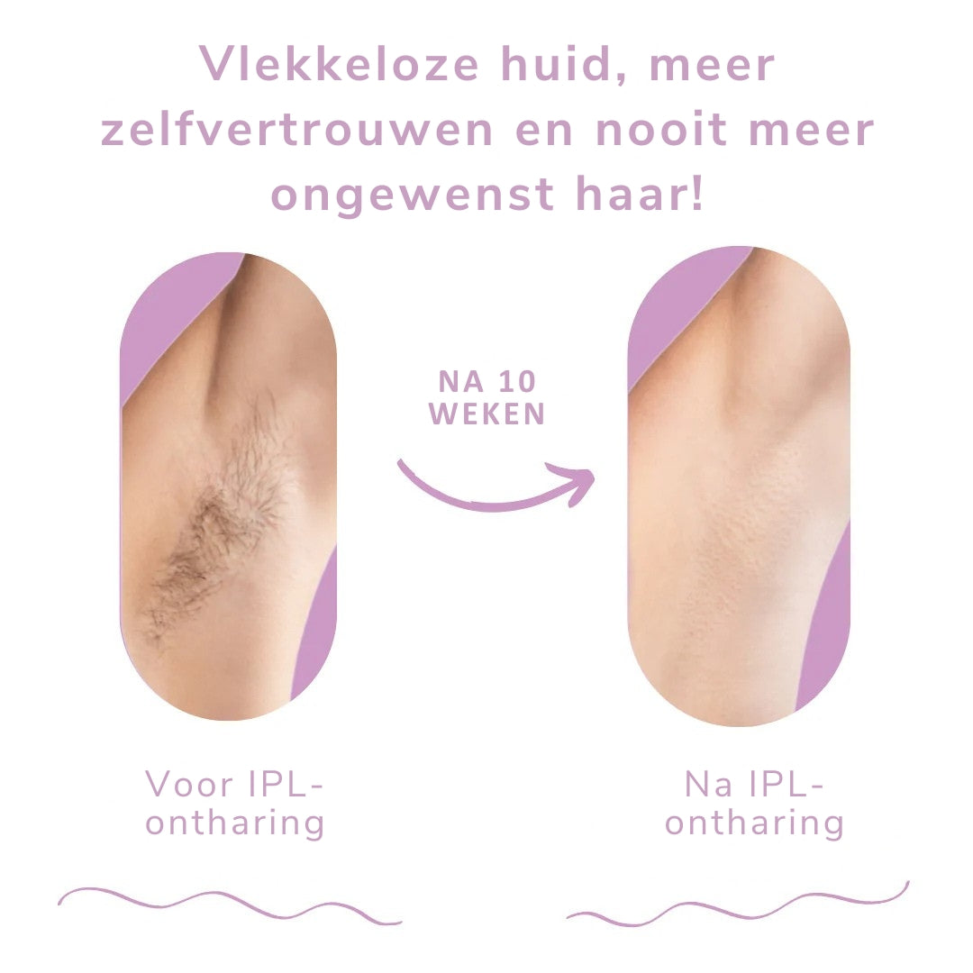 Nova IPL-handstuk