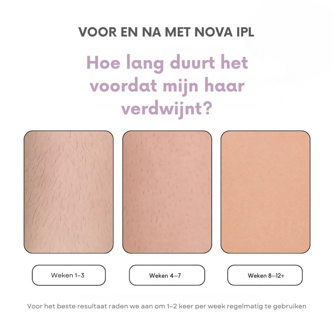 Nova IPL-handstuk