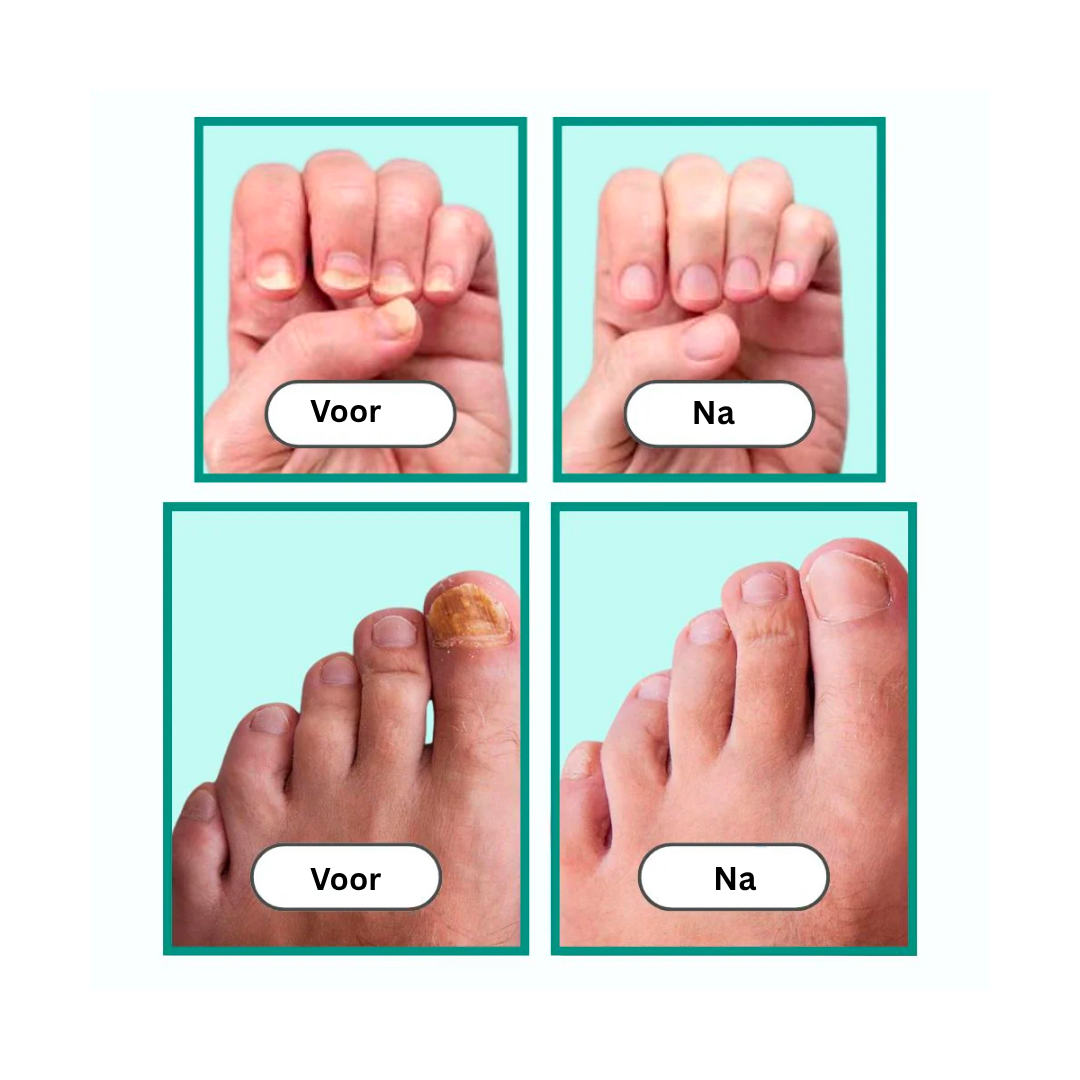 OnlyClear™ Laserbehandeling voor Schimmelnagels