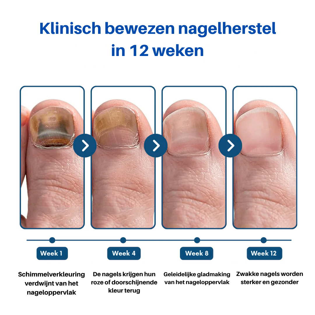 OnlyClear™ Laserbehandeling voor Schimmelnagels
