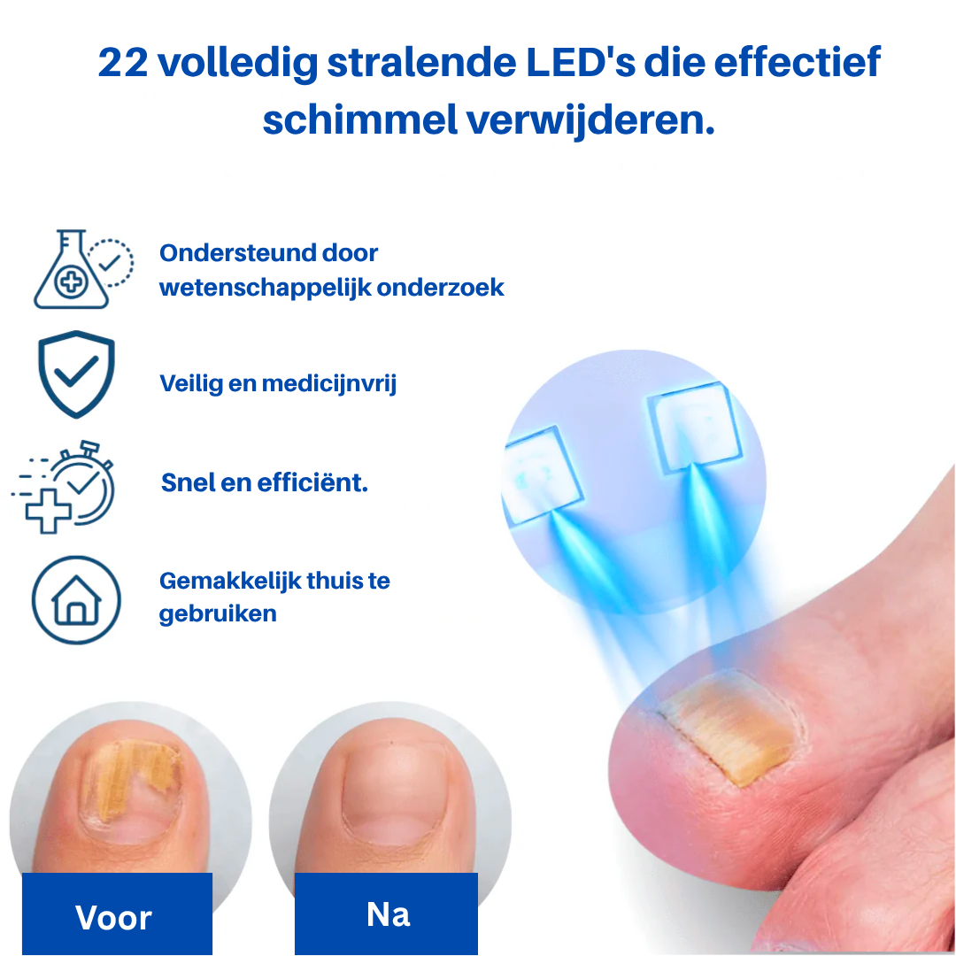 OnlyClear™ Laserbehandeling voor Schimmelnagels