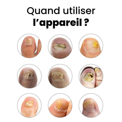 OnyClear™ – Appareil OrthoVital