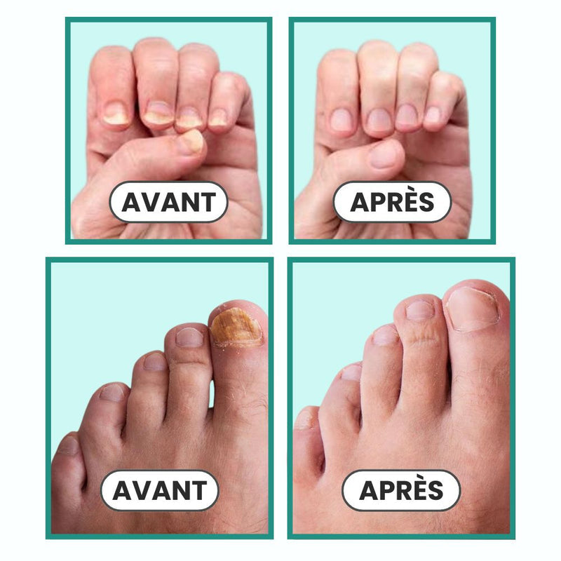 OnyClear™ – Appareil OrthoVital