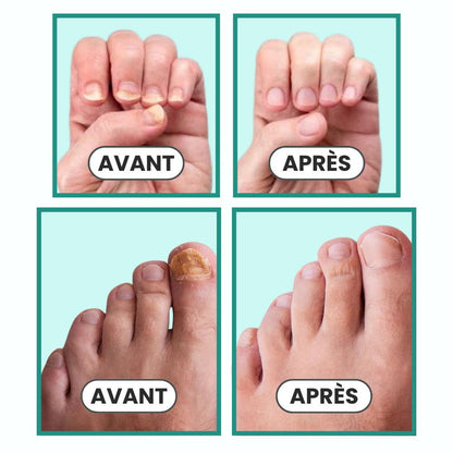 OnyClear™ – Appareil OrthoVital